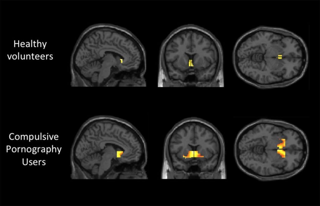 Brain activity of healthy volunteers vs compulsive users : r/freedom ...