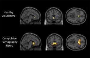Neuroscience Study Reveals Similarities Between Porn and Drug Addicts