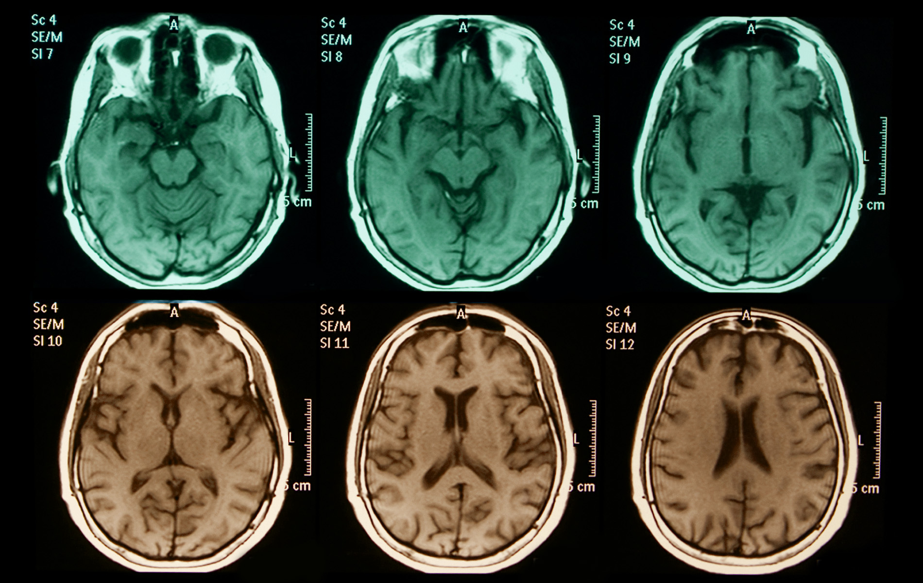 The Brain On Porn - Groundbreaking Neuroscience Study Finds Striking ...