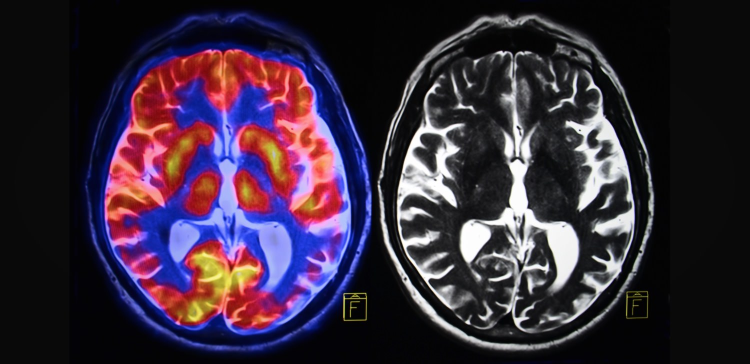 Meth Addict Sex - Porn, Addiction, and the Brain: 3 Misunderstandings ...